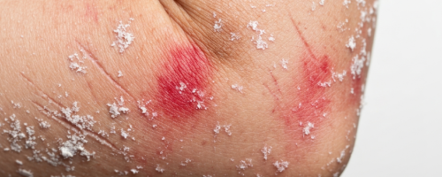 dermatitis in adults symptoms pictures