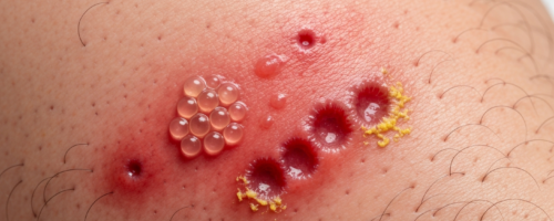 Genital herpes symptoms pictures