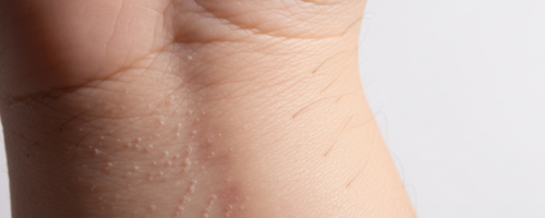 rickets symptoms pictures