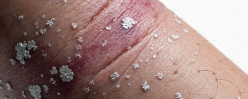atopic dermatitis symptoms pictures