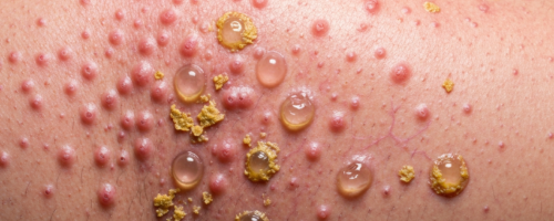 laryngitis symptoms pictures