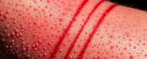scarlet fever symptoms pictures