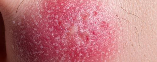 Lupus symptoms pictures