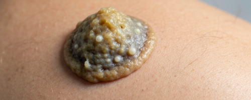 Keratosis symptoms pictures