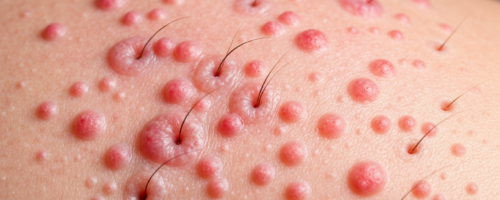 Folliculitis symptoms pictures