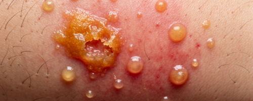 Impetigo symptoms pictures