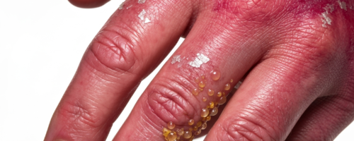 Hand dermatitis symptoms pictures