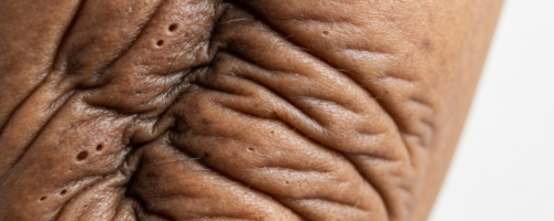 Rectal cancer symptoms pictures