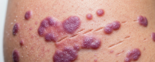 Lymphoma symptoms pictures