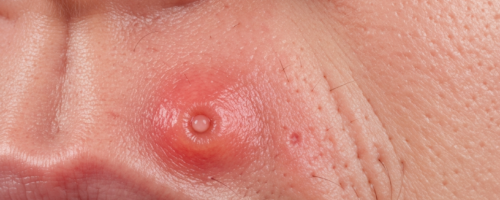 Dental cyst symptoms pictures