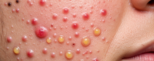 Acne on the face symptoms pictures