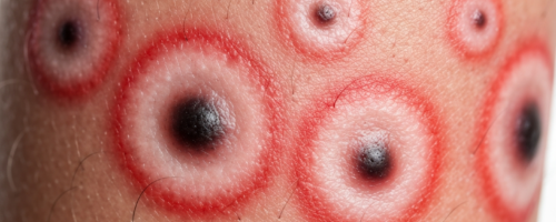 pneumonia symptoms pictures