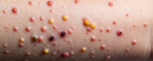 Gonorrhea in men symptoms pictures