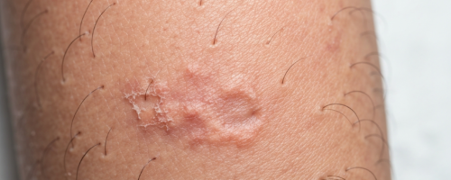Spinal hernia symptoms pictures