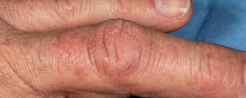 Osteoarthritis symptoms pictures