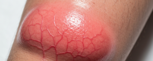 osteogenic sarcoma symptoms pictures